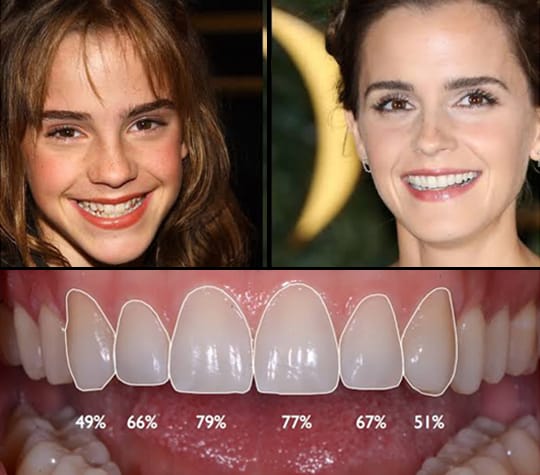 Smile Makeover
